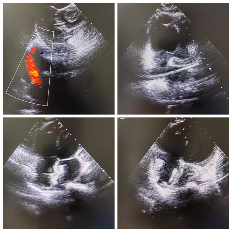 心内膜垫缺损超声图片