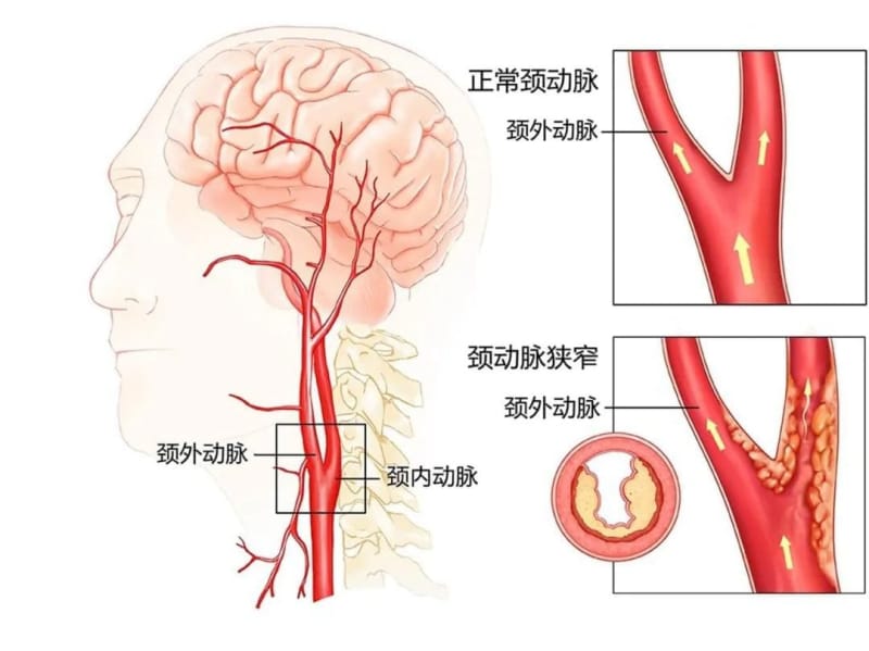 【州医科普】刘龙生：重视颈动脉狭窄早期治疗降低卒中的发生率